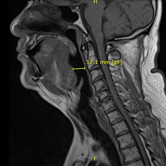 Post-operation MRI of airway with BTTT OSA implant in-situ