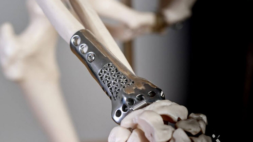 perforated patented 3D printed radial bone screwed to a squeleton