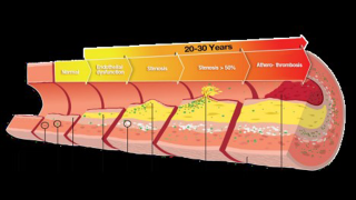 A graph showing the progressive worsening of a blood vessel condition through the years, leading to plaque and stiffening of walls