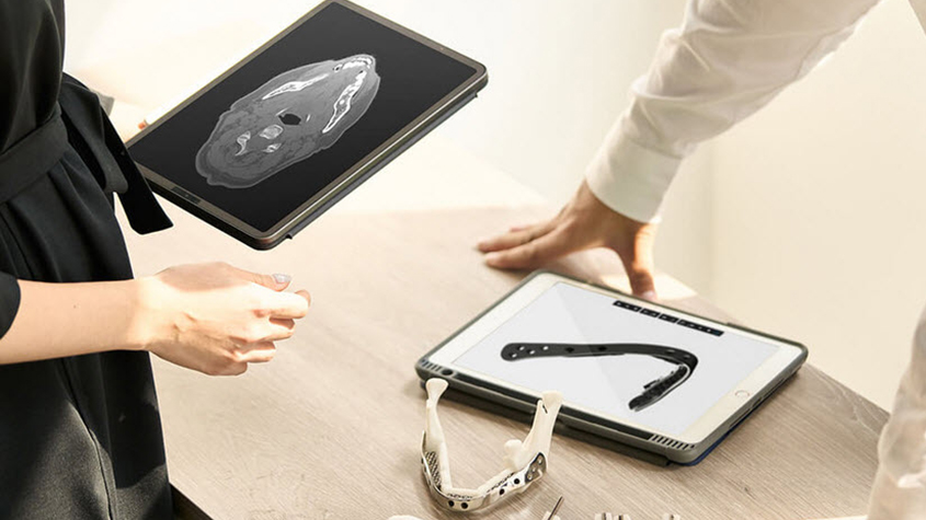 Patient’s tomography after which the bone replacement is modeled through an AI-assisted program