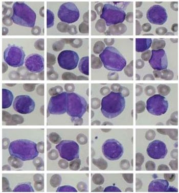 Một slide hiển thị các tế bào máu bất thường